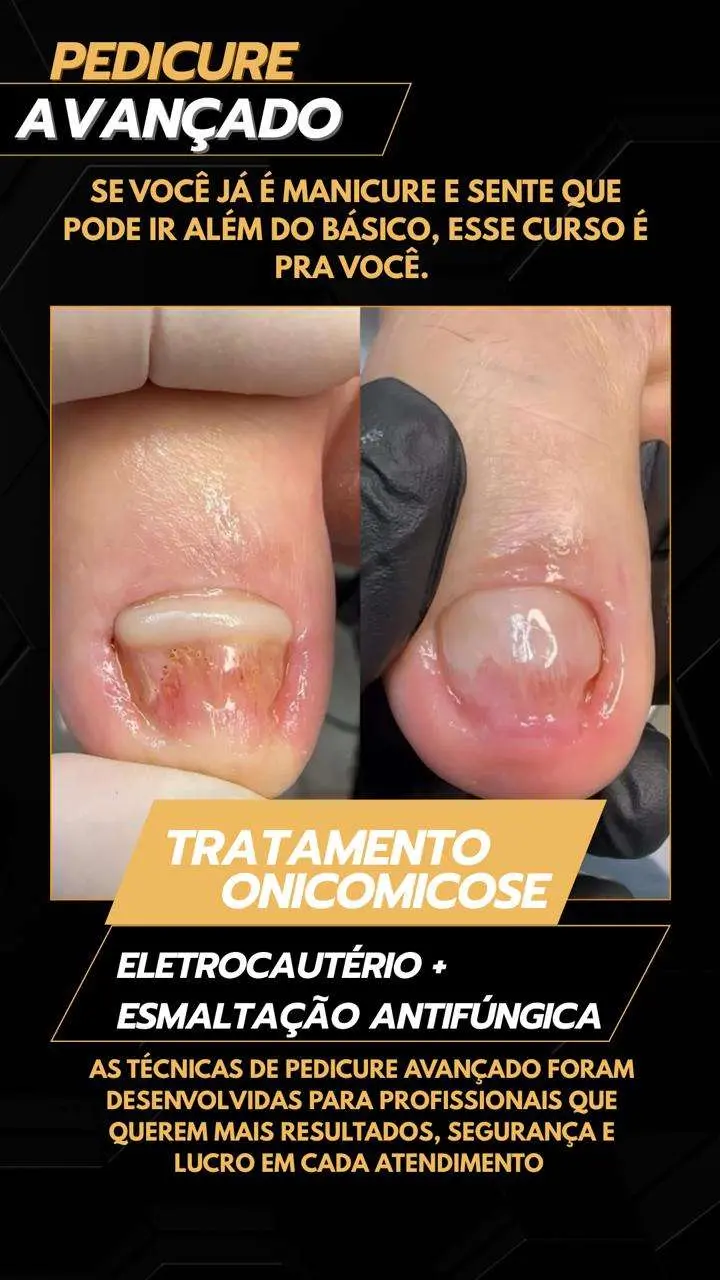 Antes e depois de procedimento Podocure