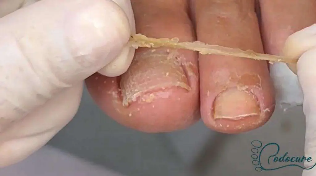 Peeling Podocure